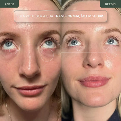 Vaculia EyeLift™
