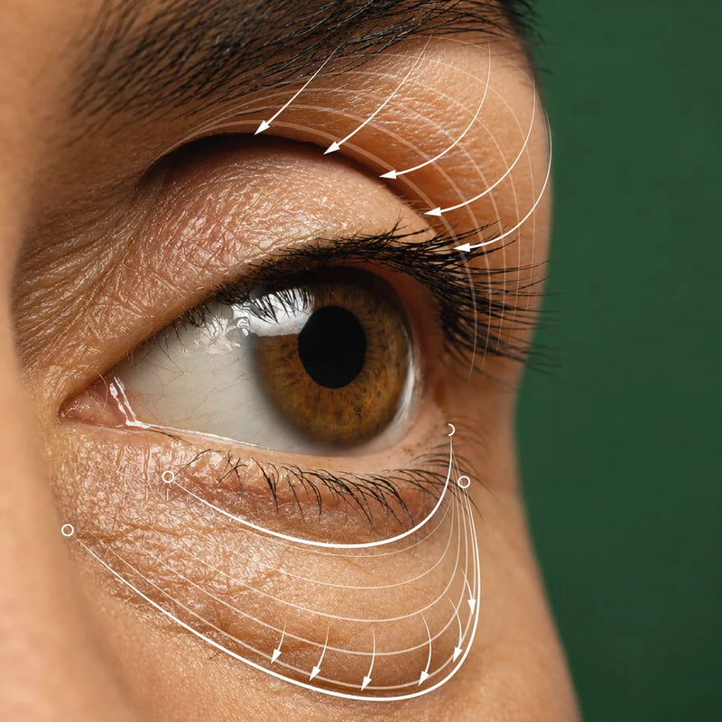 Olheiras e inchaço sob os olhos